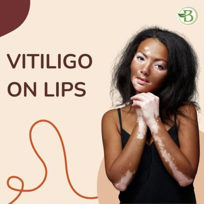 vitiligo-treatment-naturally-treatment-for-white-spot-on-skin-by-homeopathy-big-0