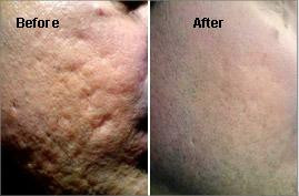 fractional-co2-laser-treatment-in-jalandhar-big-0