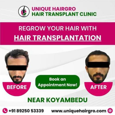 best-hair-transplant-doctors-near-me-big-3