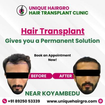 best-hair-transplant-doctors-near-me-big-1