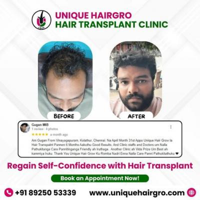 best-hair-transplant-doctors-near-me-big-2