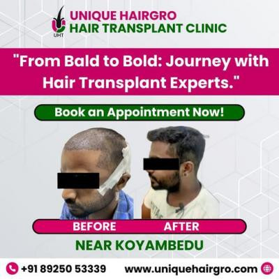 best-hair-transplant-clinic-in-tamilnadu-big-1