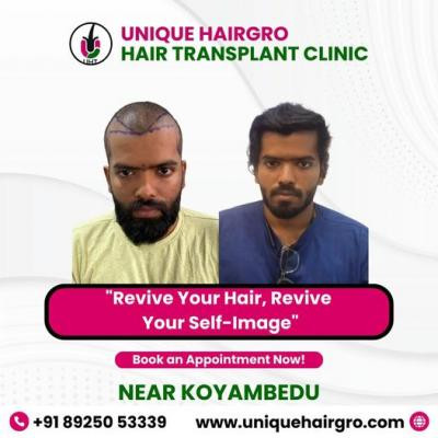 best-hair-transplant-clinic-in-tamilnadu-big-0