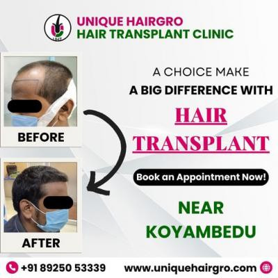 best-hair-transplant-clinic-in-tamilnadu-big-2