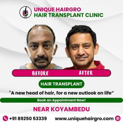 best-hair-transplant-clinic-in-tamilnadu-big-3