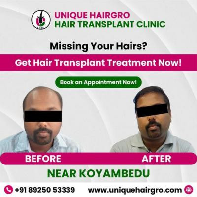 best-hair-transplant-clinic-in-tamilnadu-big-2