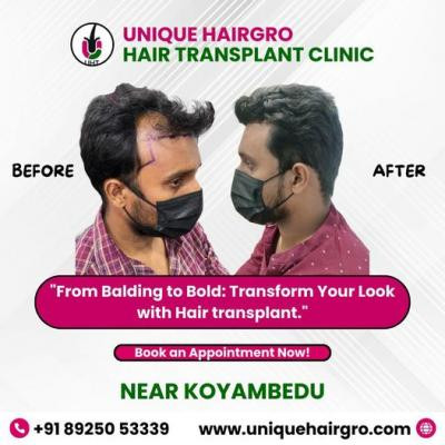 best-hair-care-clinic-chennai-big-1