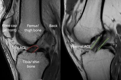 acl-injuries-london-big-0