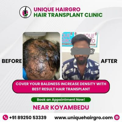 hair-transplant-cost-in-chennai-big-2